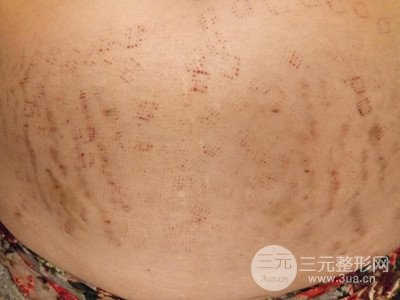 武漢一美王朝暉激光去妊娠紋真實(shí)案例，并附上前后對(duì)比圖片