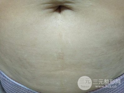 武漢一美王朝暉激光去妊娠紋真實(shí)案例，并附上前后對(duì)比圖片