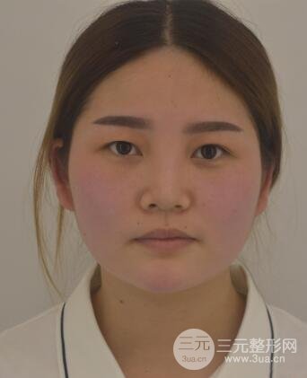 全切開雙眼皮價(jià)格和恢復(fù)過程對比圖片