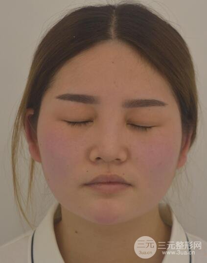 全切開雙眼皮價(jià)格和恢復(fù)過程對比圖片