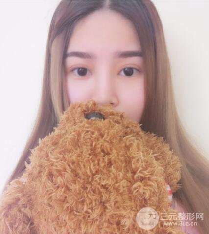 全切開雙眼皮價(jià)格和恢復(fù)過程對比圖片