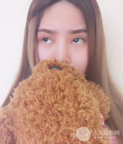 全切開雙眼皮價(jià)格和恢復(fù)過程對比圖片