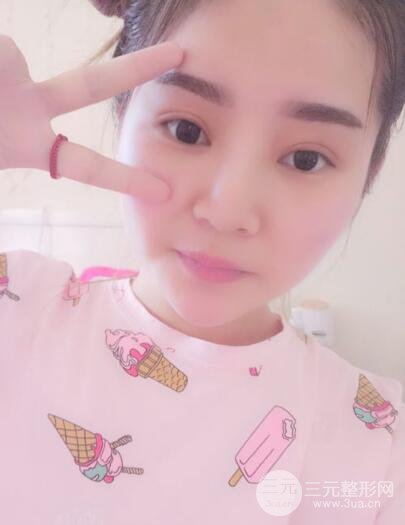 全切開雙眼皮價(jià)格和恢復(fù)過程對比圖片