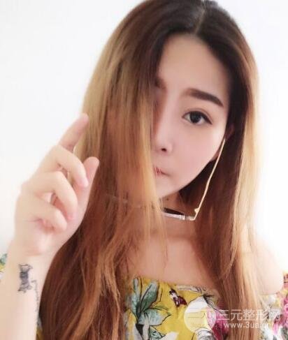 全切開雙眼皮價(jià)格和恢復(fù)過程對比圖片