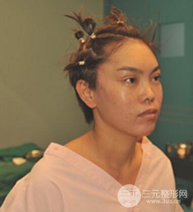 去做了埋線面b提拉術(shù)果很是不錯