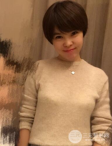 去做了埋線面b提拉術(shù)果很是不錯