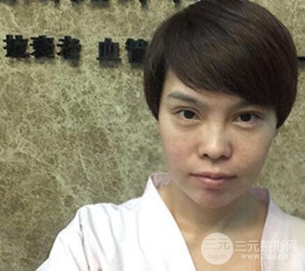 去做了埋線面b提拉術(shù)果很是不錯