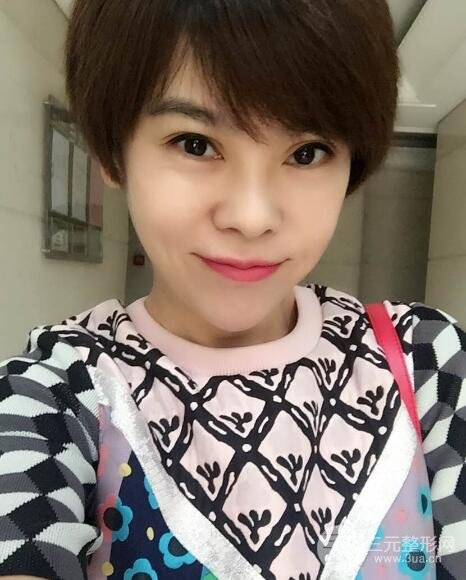 去做了埋線面b提拉術(shù)果很是不錯