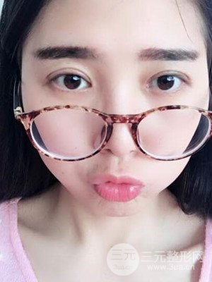 雙眼皮真實(shí)案例分享——武漢繹君毛林醫(yī)生做的