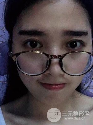 雙眼皮真實(shí)案例分享——武漢繹君毛林醫(yī)生做的