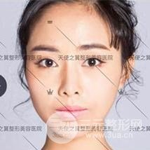 面部自體脂肪填充+隆鼻整形+雙眼皮案例，恢復果照片~