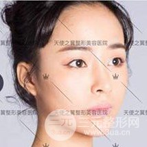 面部自體脂肪填充+隆鼻整形+雙眼皮案例，恢復果照片~