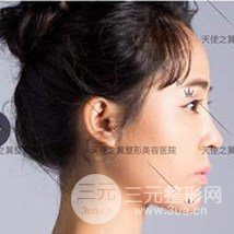 面部自體脂肪填充+隆鼻整形+雙眼皮案例，恢復果照片~