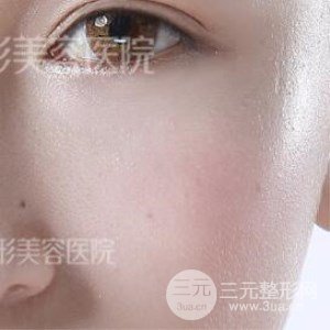 芭比雙眼皮+去眼袋案例分享，還有恢復過程照片哦~