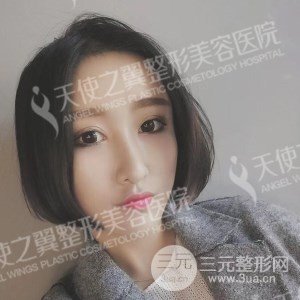 芭比雙眼皮+去眼袋案例分享，還有恢復過程照片哦~