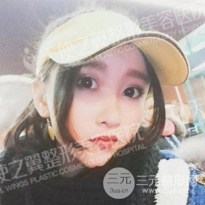 芭比雙眼皮+去眼袋案例分享，還有恢復過程照片哦~