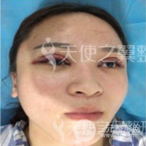 芭比美眼+假體隆胸真是案例果圖片分享~