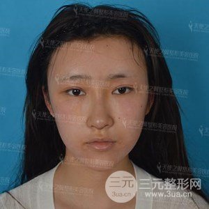 自體脂肪面部填充+全鼻金雕真實案例，恢復照片分享~