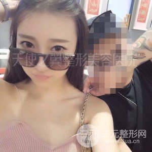 自體脂肪面部填充+全鼻金雕真實案例，恢復照片分享~