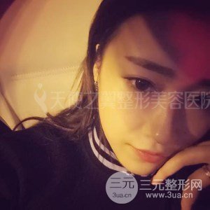 自體脂肪面部填充+全鼻金雕真實案例，恢復照片分享~