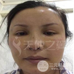 隆鼻整形修復+自體脂肪詳細部填充案例分享~