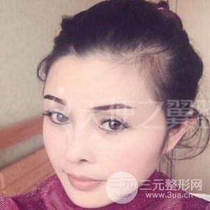 隆鼻整形修復+自體脂肪詳細部填充案例分享~