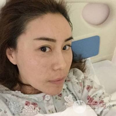 武漢美侖陳遠(yuǎn)海自體脂肪填充全臉案例，附上前后對(duì)比圖片