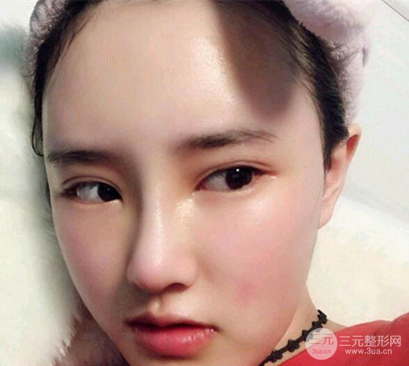 南京美范整形沈干“自體脂肪填充+隆鼻整形”真人記錄分享