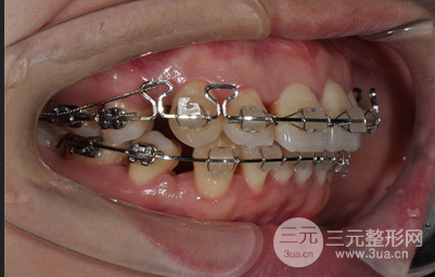 昆明醫(yī)科大學(xué)附屬口腔醫(yī)院黎明牙齒矯正果分享