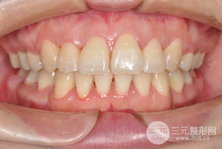 昆明醫(yī)科大學(xué)附屬口腔醫(yī)院黎明牙齒矯正果分享