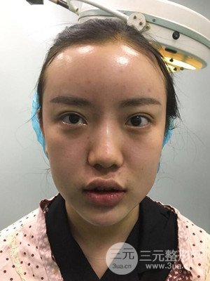 自體脂肪填充額頭+豐下巴真實案例，昆明都市儷人金海坤醫(yī)生做的