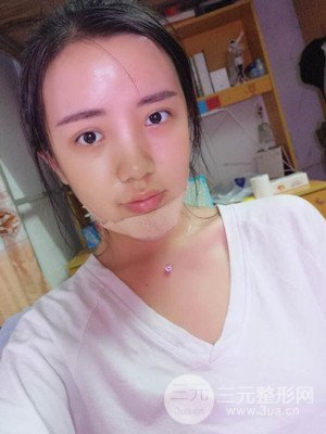 自體脂肪填充額頭+豐下巴真實案例，昆明都市儷人金海坤醫(yī)生做的