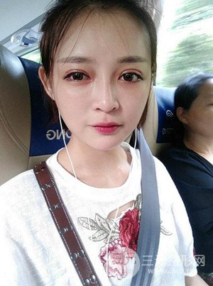 切開雙眼皮+假體隆鼻案例，前后對比圖分享