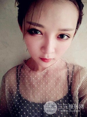 切開雙眼皮+假體隆鼻案例，前后對比圖分享