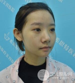 武漢希思特楊權(quán)明假體隆鼻案例日記真實(shí)記錄分享