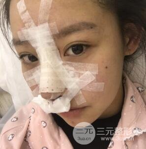 武漢希思特楊權(quán)明假體隆鼻案例日記真實(shí)記錄分享