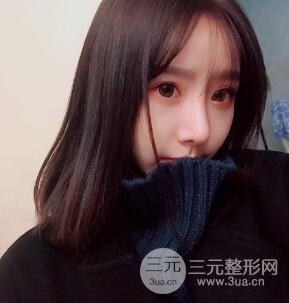 武漢希思特楊權(quán)明假體隆鼻案例日記真實(shí)記錄分享