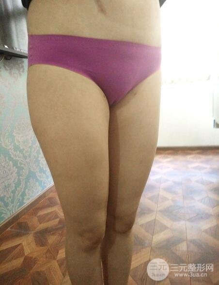 大腿抽脂后的恢復(fù)過(guò)程，真人案例真實(shí)分享