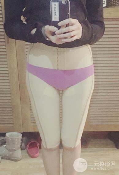 大腿抽脂后的恢復(fù)過(guò)程，真人案例真實(shí)分享