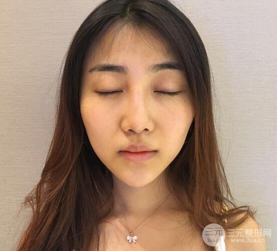 隆鼻整形術(shù)后1-7天的照片，前后對比果圖分享