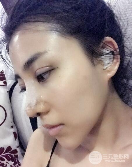 隆鼻整形術(shù)后1-7天的照片，前后對比果圖分享