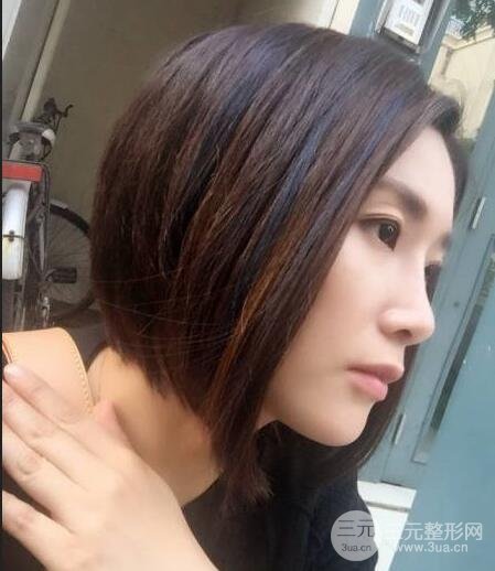 打完鼻子恢復(fù)的過(guò)程圖，隆鼻案例日記分享