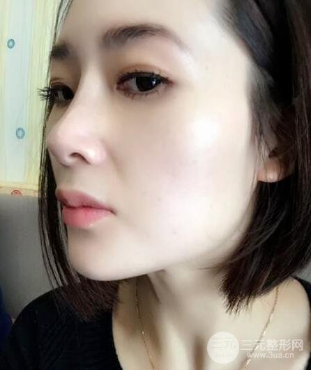 打完鼻子恢復(fù)的過(guò)程圖，隆鼻案例日記分享