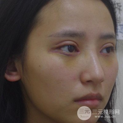 雙眼皮多項(xiàng)整形整形案例：切開雙眼皮+開內(nèi)眼角前后對(duì)比圖