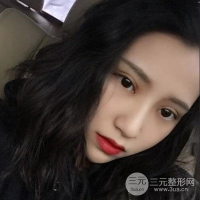 雙眼皮多項(xiàng)整形整形案例：切開雙眼皮+開內(nèi)眼角前后對(duì)比圖