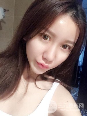 上海原辰自體脂肪填充案例，附上恢復(fù)過程以及對比圖片