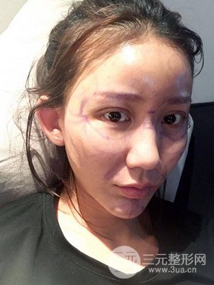 上海原辰自體脂肪填充案例，附上恢復(fù)過程以及對比圖片