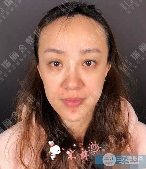 手術(shù)前臉頰凹陷嚴(yán)重的照片