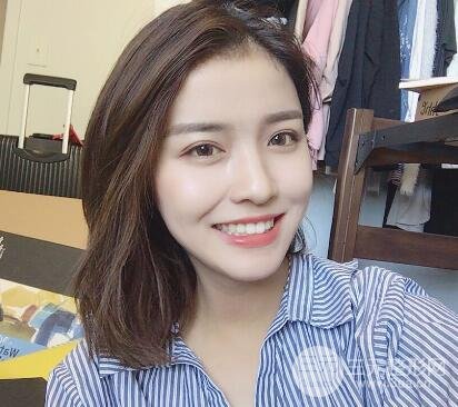 南京康美陳小劍做的雙眼皮案例果真實的分享給你們！