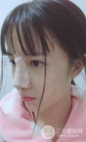 柏麗李勁良假體隆鼻案例果分享！小巧精致又立體~